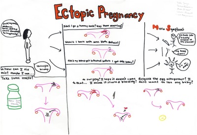 "Ectopic Pregnancy" by Vidhi Singh '20, Samuel Rabideau '20 et al.