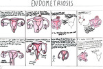 Endometriosis by Illinois Mathematics and Science Academy